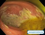 colon-ischemic-colitis-case-2-intermediate-stage