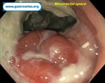 dehiscence-of-colorectal-anastomosis-anastomotic-leak
