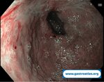 collagenous-gastritis