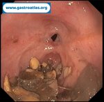 esophageal-stenosis-secondary-to-amyloidosis-part-1