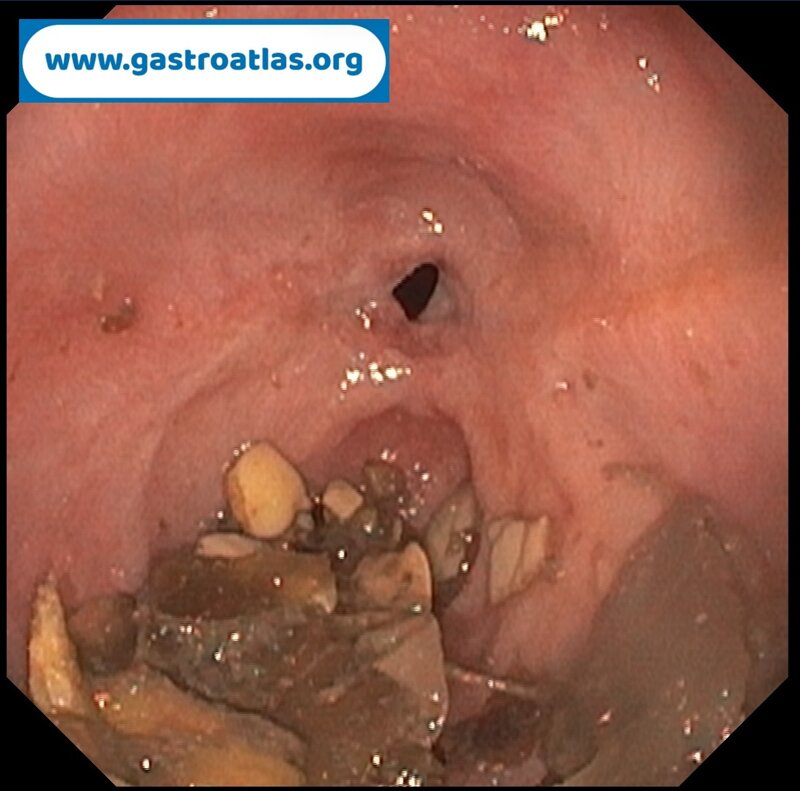 esophageal-stenosis-secondary-to-amyloidosis-part-1