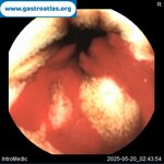videocapsule-endoscopy-vce-in-glanzmanns-thrombasthenia