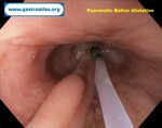 esophageal-stricture-secondary-to-amyloidosis-part-2