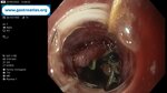 esophageal-stricture-in-endometrial-cancer