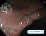 collagenous-gastritis
