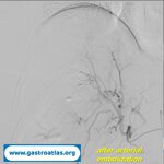 percutaneous-liver-biopsy-hematoma