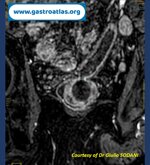 pre-anastomotic-fistula-in-colorectal-anastomosis-part-2-mri-view