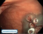hemostatic-clip-a-fundamental-tool-in-endoscopy