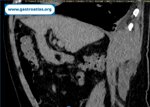 duodenal-duplication-cyst