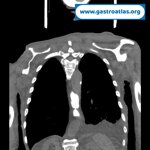 esophageal-stenosis-secondary-to-amyloidosis-part-1