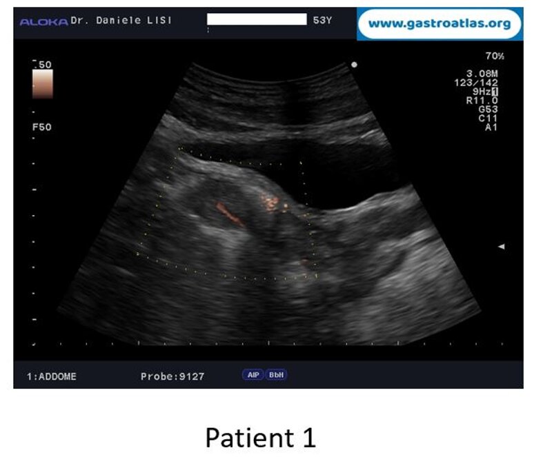 opportunistic-screening-by-abdominal-ultrasound-scan-colon-polyps-as-incidental-findings