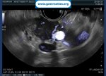 pancreatic-adenocarcinoma-abdominal-us-ct-scan-eus-fnb-and-surgery-imaging