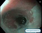barrett-esophagus