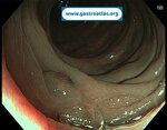 colonic-inverted-diverticulum-icd