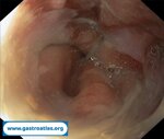 cmv-esophagitis