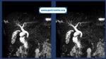 choledocholithiasis-ercp