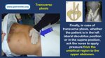 role-of-the-endoscopy-nurse-auxiliary-maneuvers