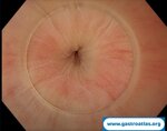 advancing-esophageal-motility-treatment-with-poem-and-endoflip