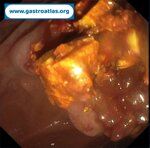 choledocholithiasis-ercp
