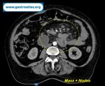 small-bowel-adenocarcinoma-sba-resulting-from-undiagnosed-celiac-disease