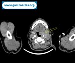 tonsil-lymphoma