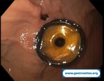 gastric-ulcer-in-percutaneous-endoscopic-gastrostomy-peg