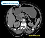 small-bowel-adenocarcinoma-sba-resulting-from-undiagnosed-celiac-disease