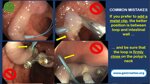 endoloop-polypectomy-tips-and-tricks