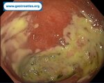 colon-ischemic-colitis-case-2-intermediate-stage