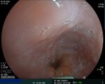 real-time-view-of-ultrasound-eus