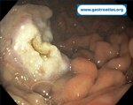 gastric-metastasis-from-renal-cell-carcinoma