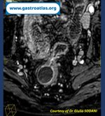 pre-anastomotic-fistula-in-colorectal-anastomosis-part-2-mri-view