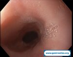barrett-esophagus