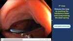 endoloop-polypectomy-tips-and-tricks