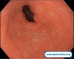 collagenous-gastritis
