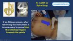 role-of-the-endoscopy-nurse-auxiliary-maneuvers