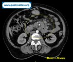 small-bowel-adenocarcinoma-sba-resulting-from-undiagnosed-celiac-disease