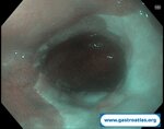 barrett-esophagus