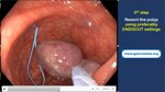 endoloop-polypectomy-tips-and-tricks