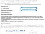 tonsil-lymphoma