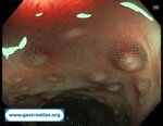 antibiotic-associated-colitis-caa-and-clostridium-difficile-infection-cdi