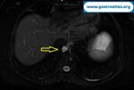 real-time-view-of-ultrasound-eus
