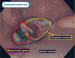 dehiscence-of-colorectal-anastomosis-anastomotic-leak