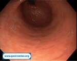 collagenous-gastritis
