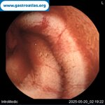 videocapsule-endoscopy-vce-in-glanzmanns-thrombasthenia