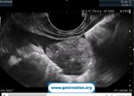 real-time-view-of-ultrasound-eus