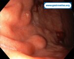 gastric-net-in-atrophic-gastritis