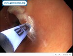 argon-plasma-coagulation-apc-treatment-of-gastric-antral-vascular-ectasia-gave