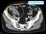 appendicitis