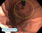 esophageal-adenocarcinoma-in-gastric-banding